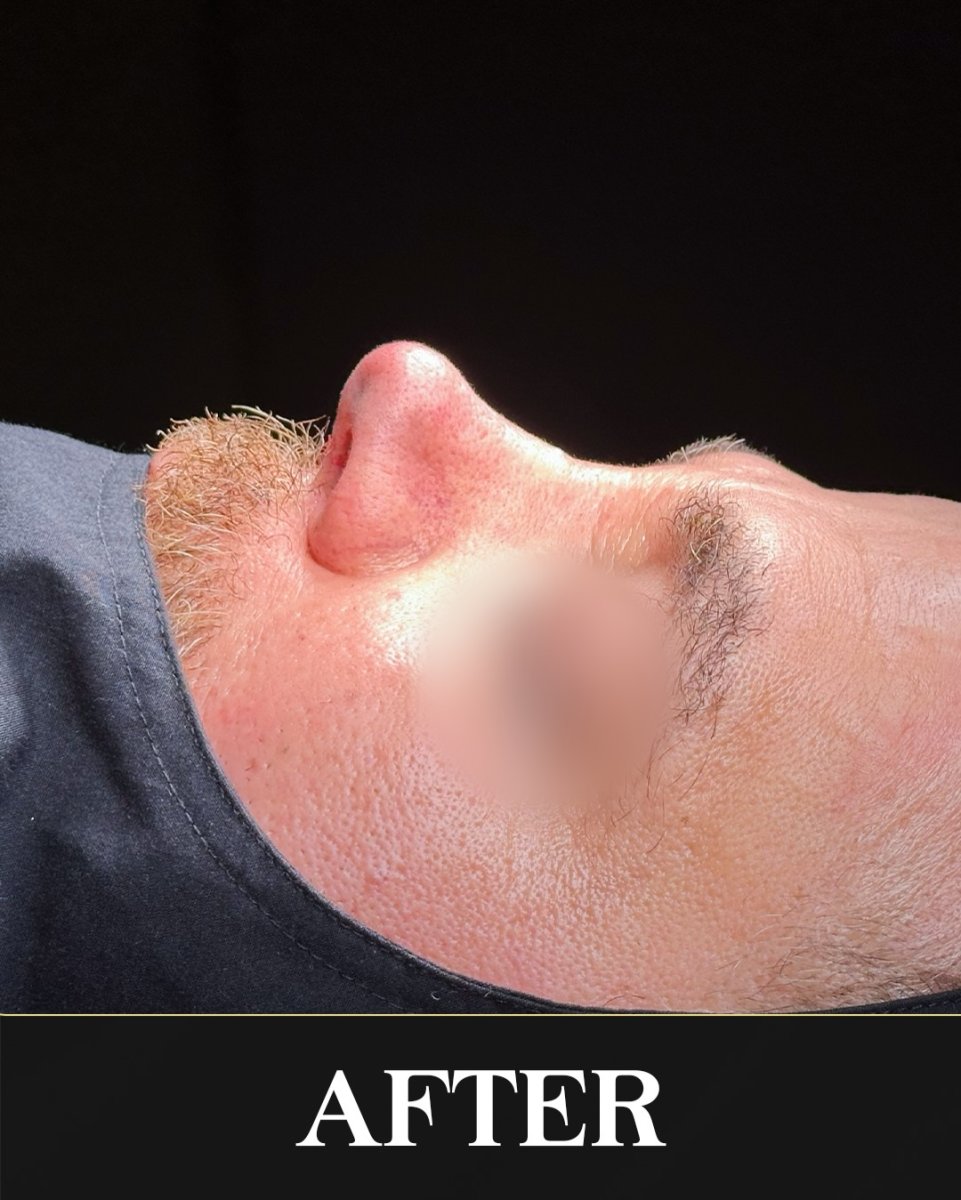 نتيجة تجميل الأنف للرجال، تحسين شكل الأنف بعد الجراحة، منظر جانبي