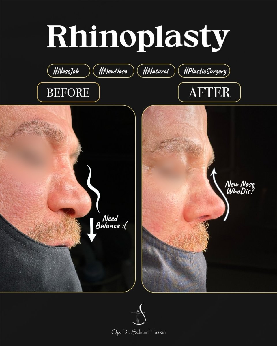 Resultado de rinoplastia antes y después por Dr. Selman Taskin, mejora de la forma nasal