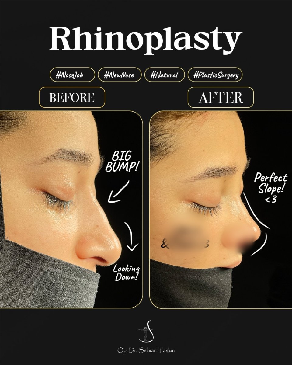 Before and after rhinoplasty results, nose reshaping with natural contour improvement