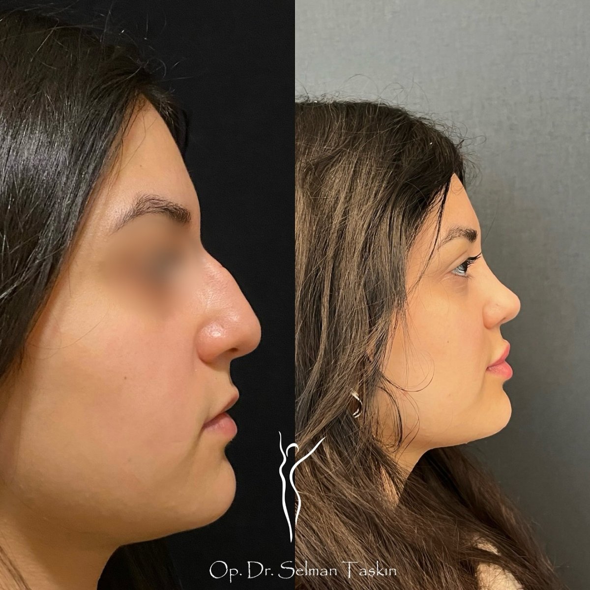 نتائج عملية تجميل الأنف قبل وبعد في عيادة د. سلمان تاشكين، تحسين شكل الأنف