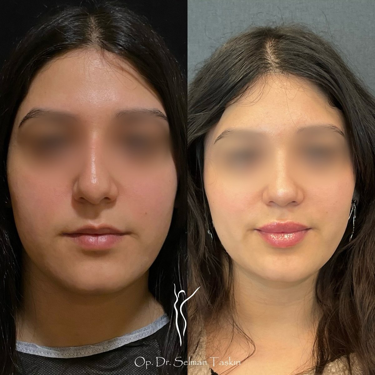 نتائج عملية تجميل الأنف قبل وبعد مع د. سلمان تاشكين، إعادة تشكيل الأنف بمظهر طبيعي