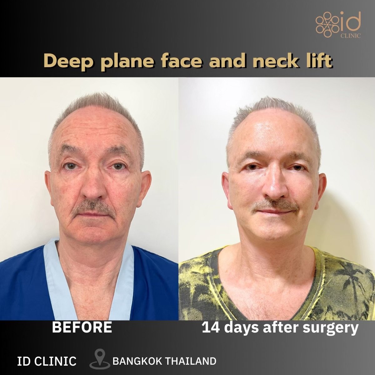 Resultados antes y después de lifting facial y de cuello deep plane en ID Clinic Bangkok