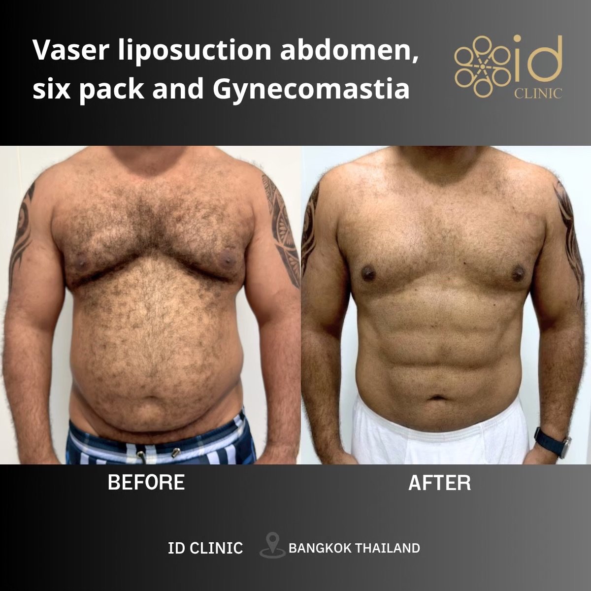 Результаты до и после Vaser липосакции и гинекомастии в ID Clinic Bangkok, пресс