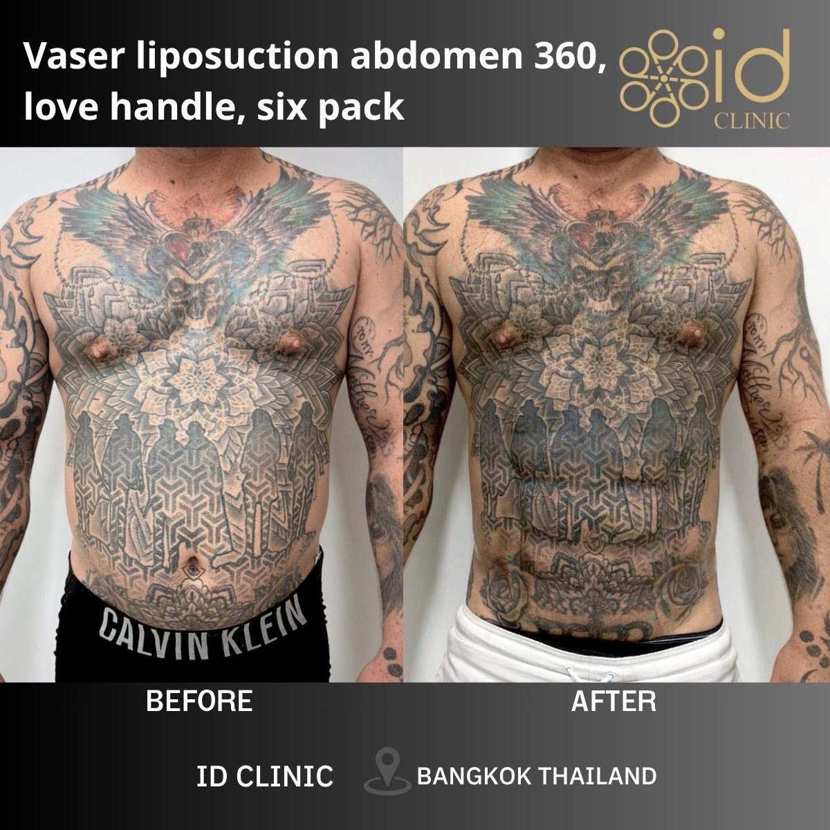 Результаты до и после Vaser абдоминального этчинга в ID Clinic Bangkok для пресса