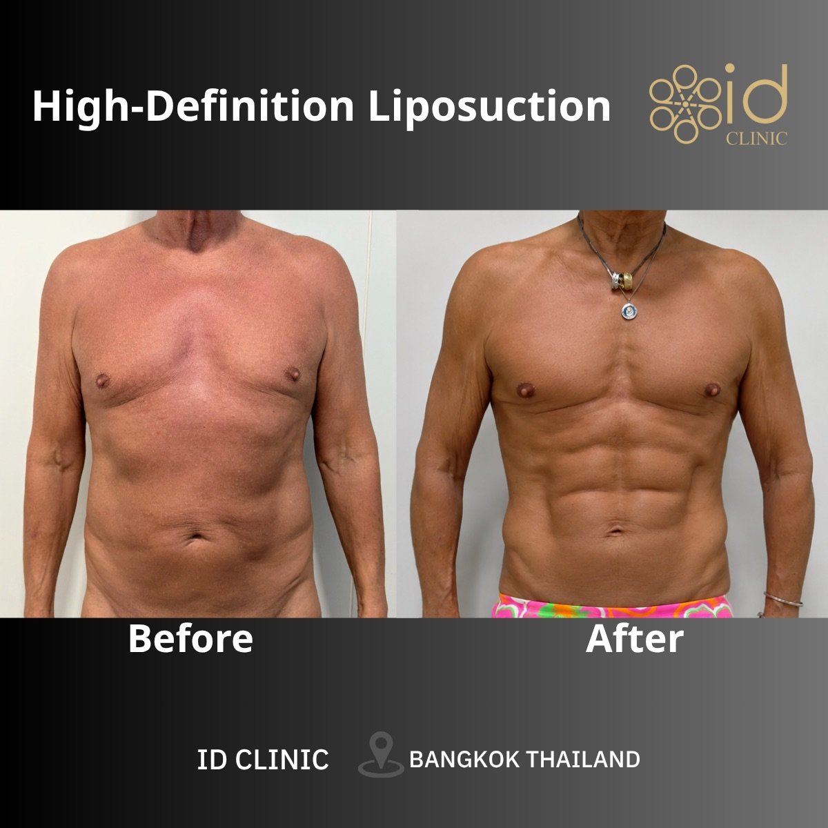 Before and after abdominal etching (six pack abs) result at ID Clinic Bangkok