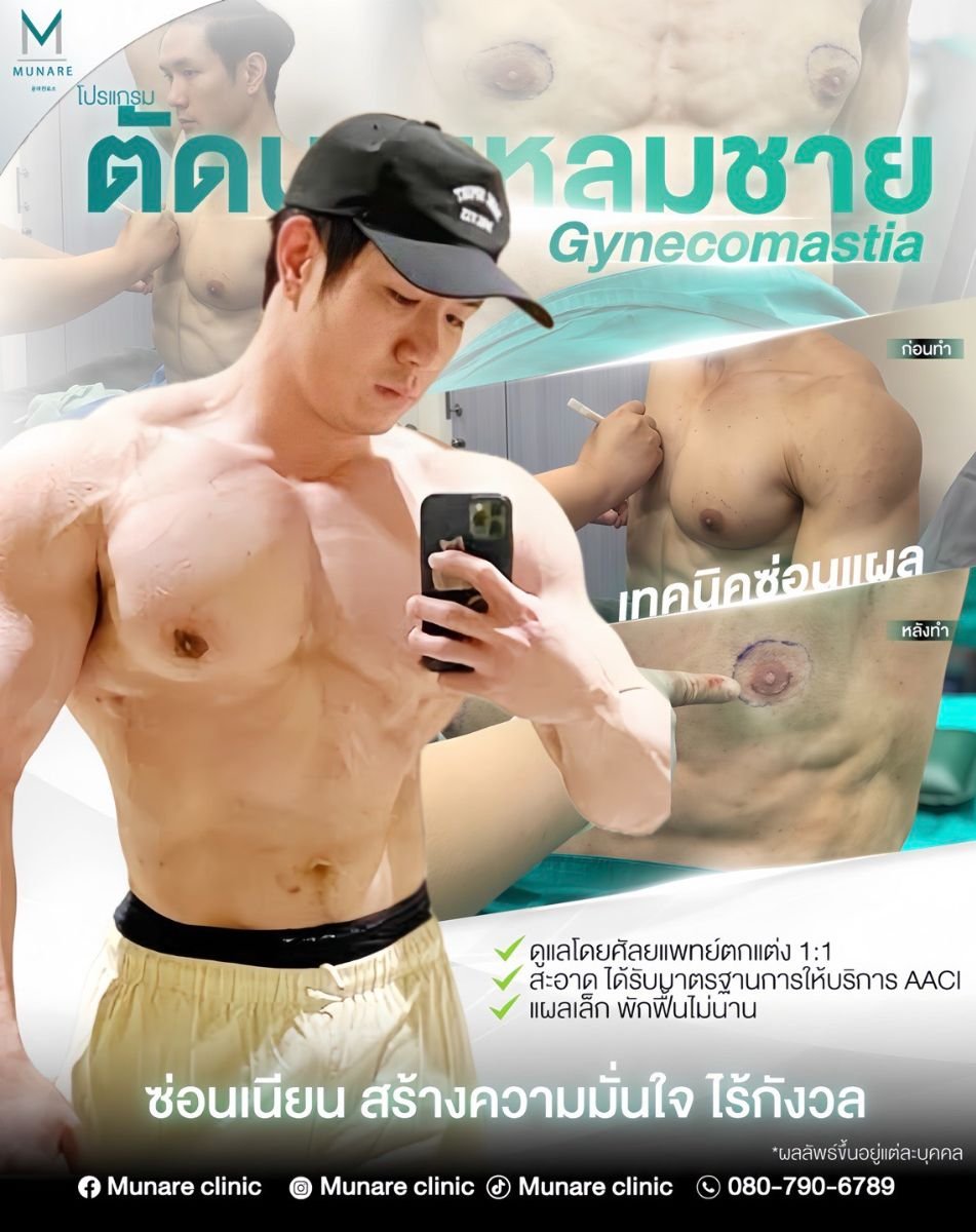 Resultados antes y después de ginecomastia en Munare Clinic Chiangmai, contorno masculino