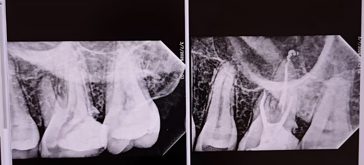 نتائج أشعة قبل وبعد علاج الجذور في عيادة Punta Cana dentist odontologia familiar