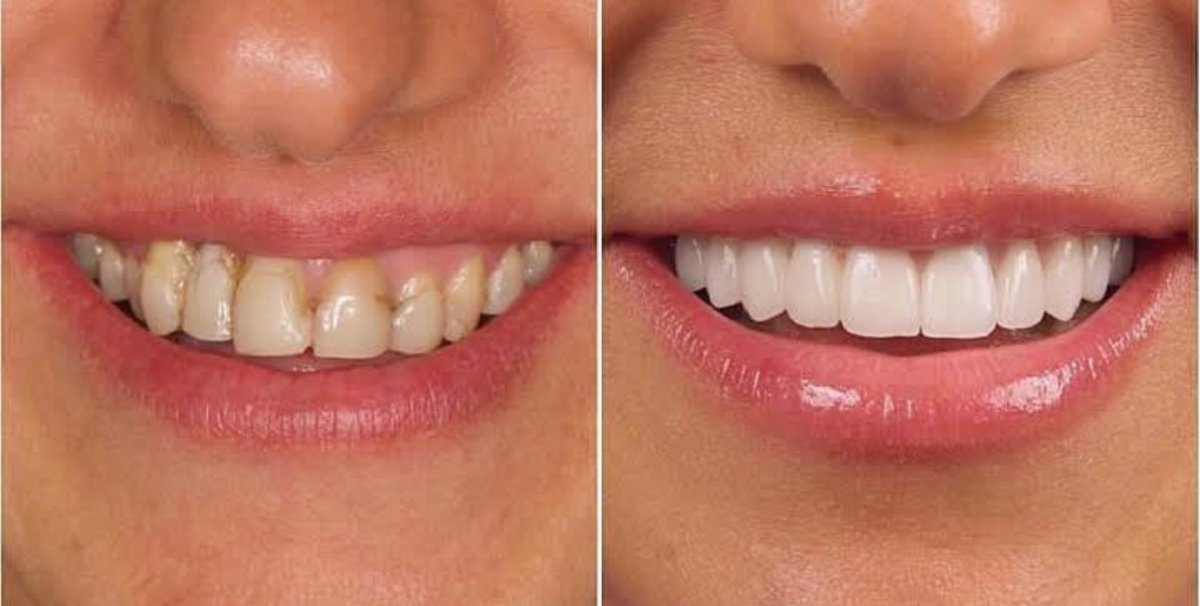 До та після встановлення вінірів у Hegazy Dental Clinic, перетворення усмішки з природним результатом
