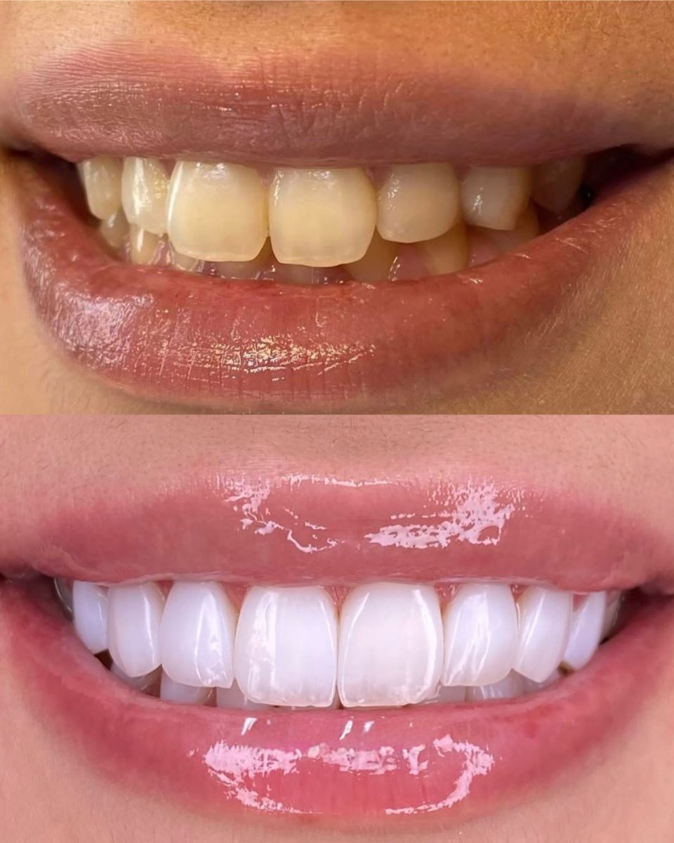 До і після вінірів у Hegazy Dental Clinic – перетворення посмішки, білі зуби