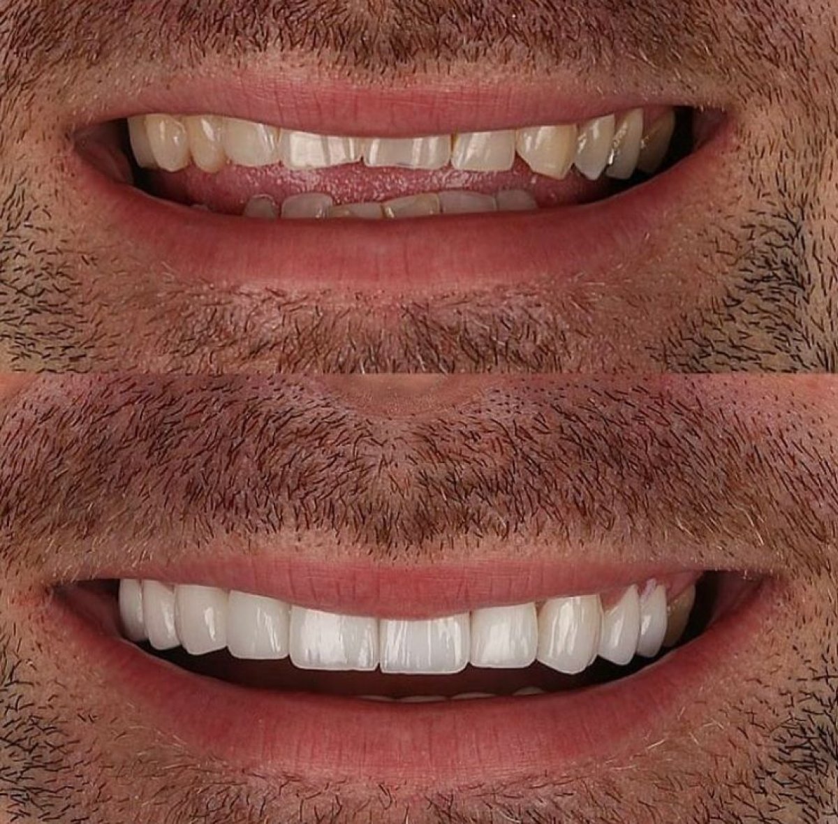 Resultados de antes y después de carillas dentales en Hegazy Dental Clinic