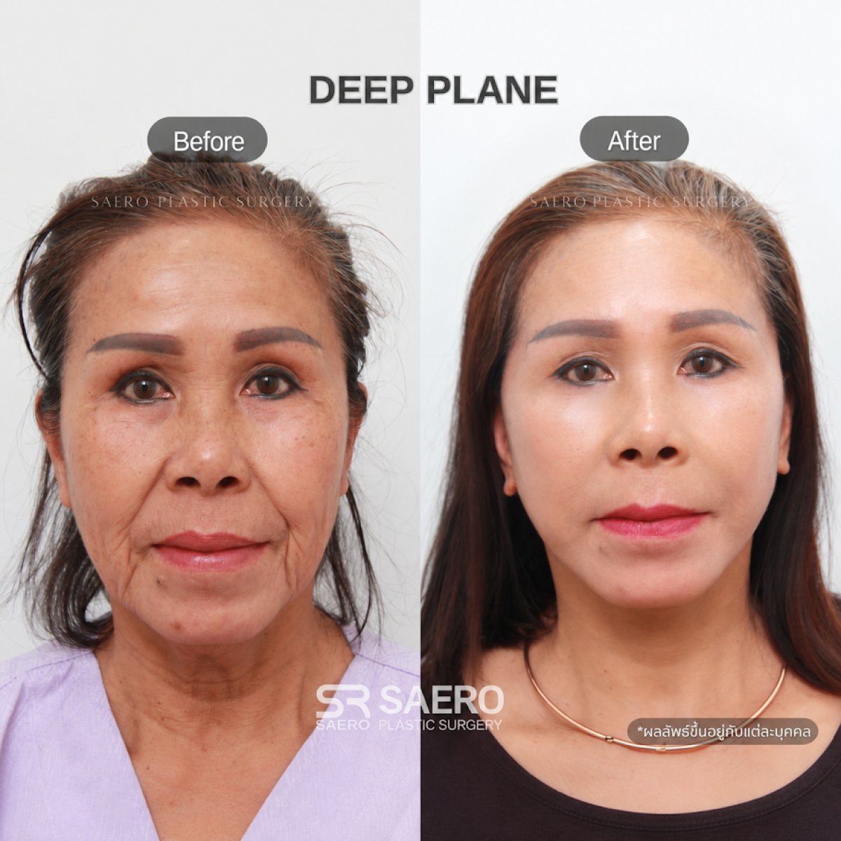 Résultats avant/après lifting deep plane chez SAERO Plastic Surgery, rajeunissement du visage