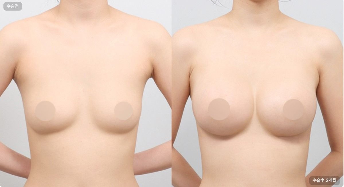 Результати до і після зменшення грудей в AB Plastic Surgery, помітне покращення форми