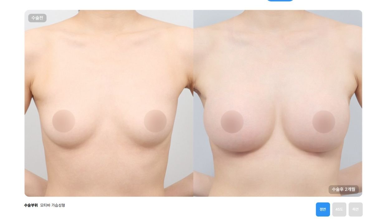 نتائج تصغير الثدي قبل وبعد في AB Plastic Surgery – تحسين شكل الثدي