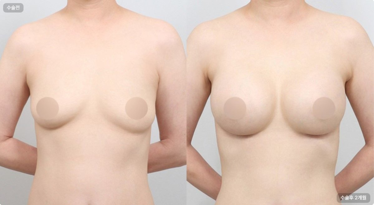 Результати до і після зменшення грудей у AB Plastic Surgery, покращений контур грудей