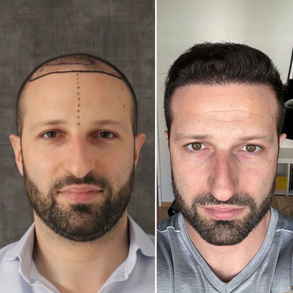 Before and after DHI hair transplant result at Este Favor Hair Transplant Clinic, restored hairline