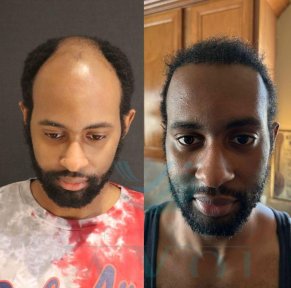 Standard Afro hair transplant (4000 Grafts) All Included - photo 4