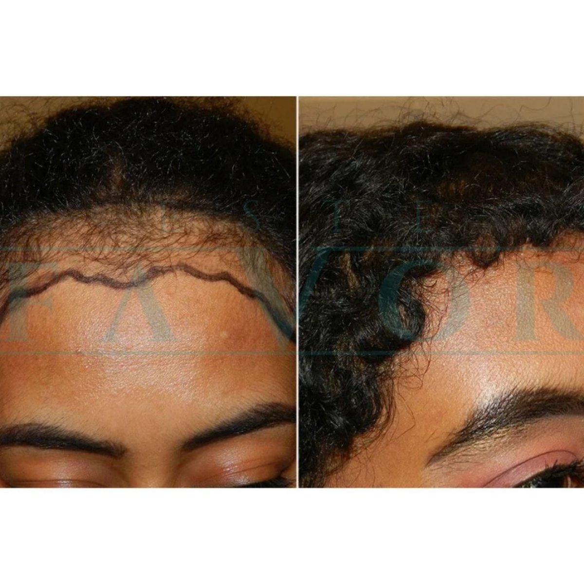 Afro hair transplant before and after results at Este Favor Hair Transplant Clinic, fuller hairline