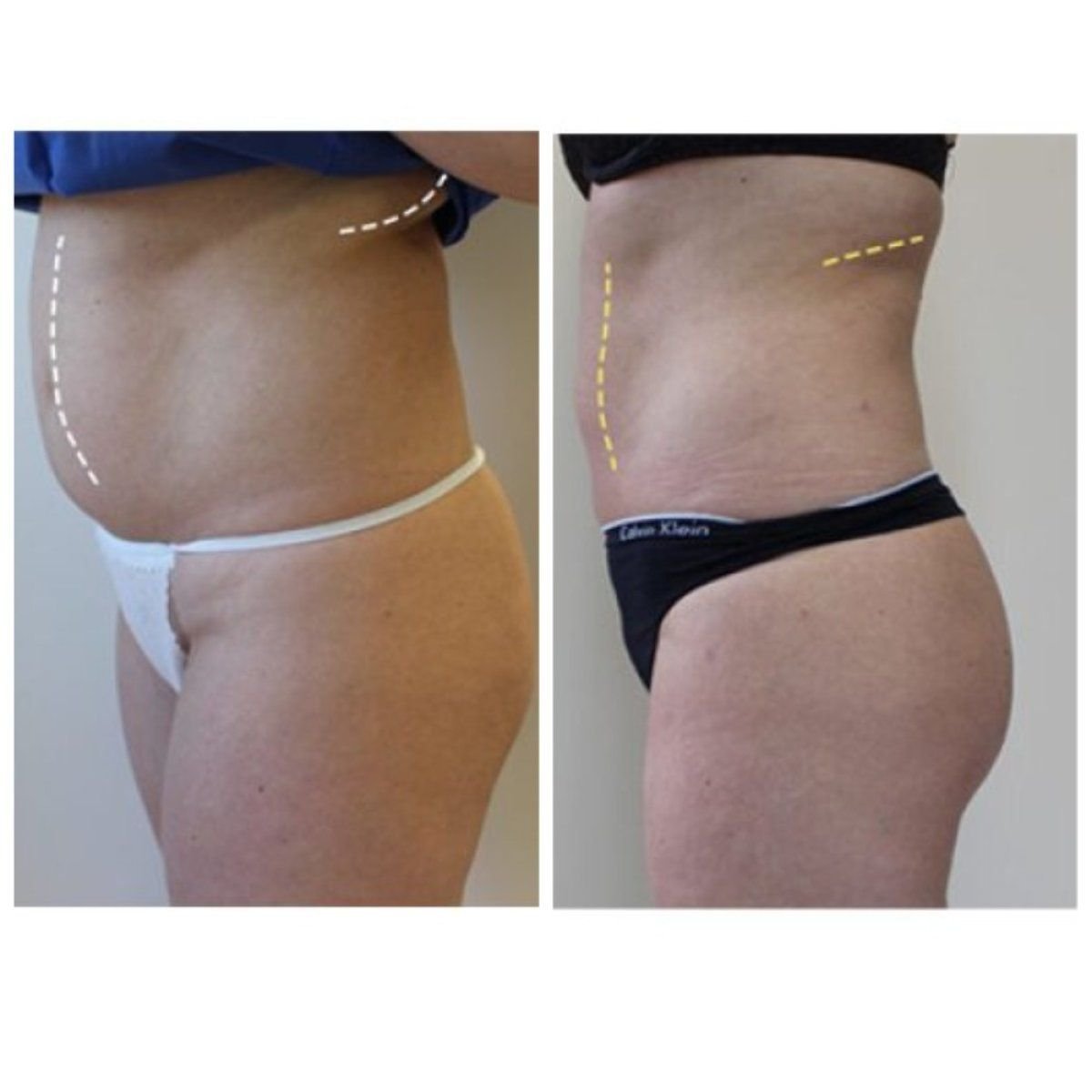 Resultados de abdominoplastia antes y después en Klinika La Perla – abdomen más plano