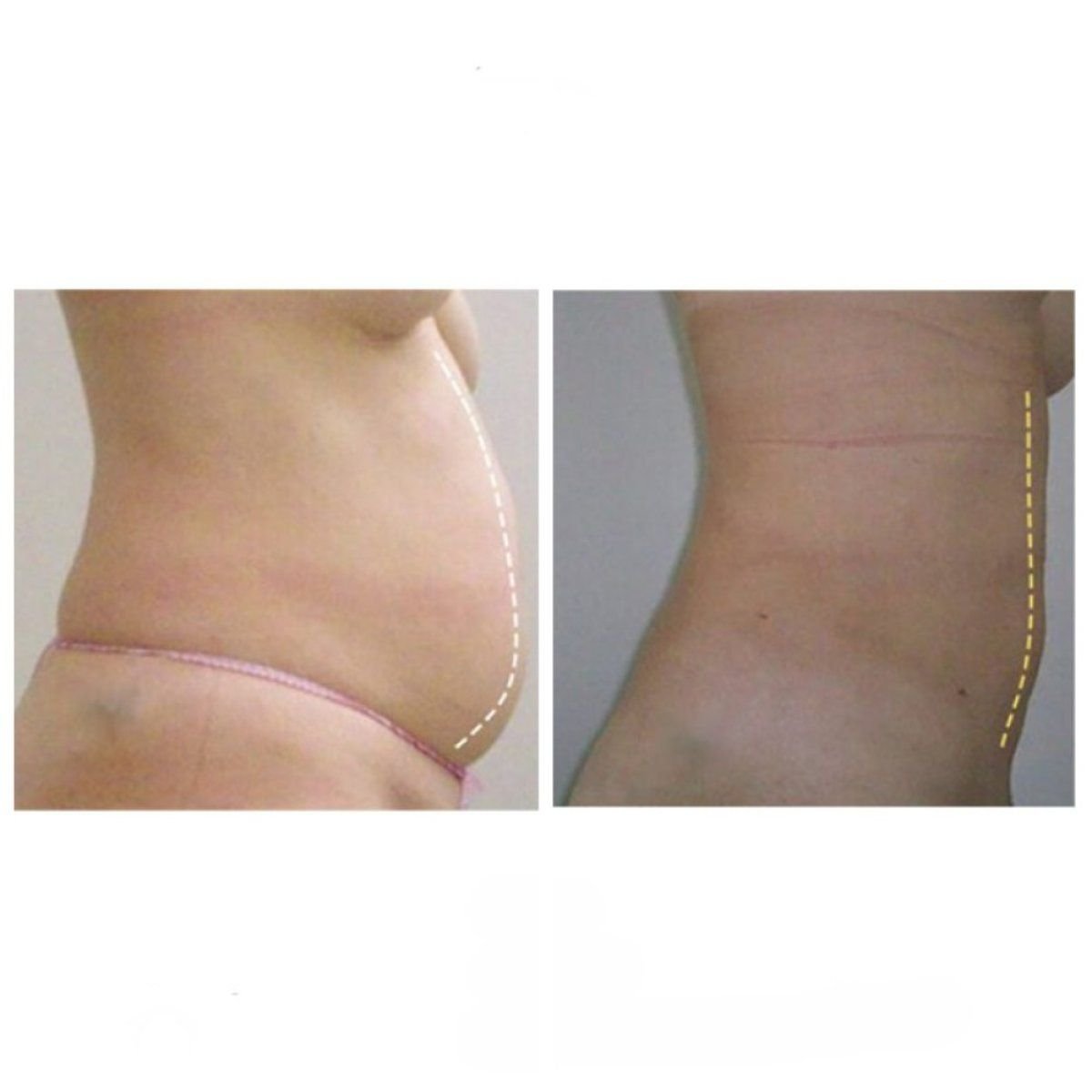 Resultados de abdominoplastia antes y después en Klinika La Perla – abdomen más plano