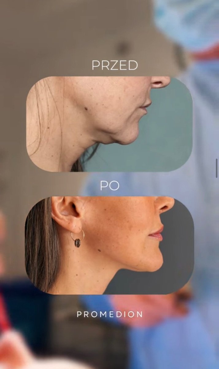Before and after mini facelift results at Klinika Promedion – improved jawline contour