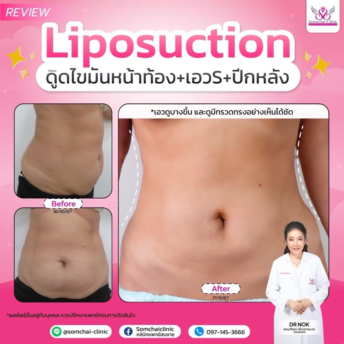 Before and after liposuction results at Somchai Clinic – slimmer abdomen, waist, and back