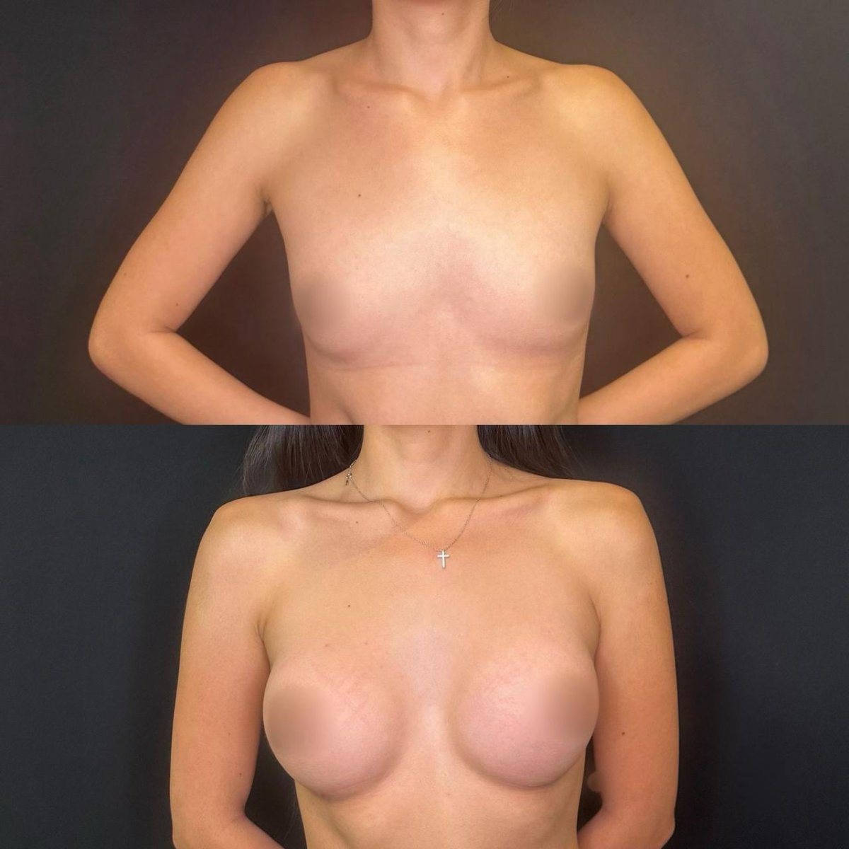 Before and after breast augmentation results at Zafir Medical Center, enhanced breast shape