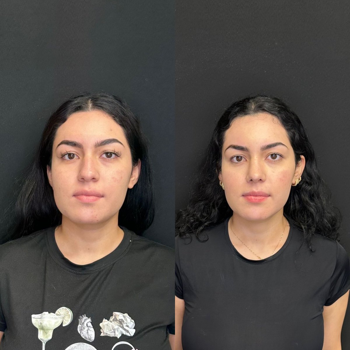 Before and after rhinoplasty results at Zafir Medical Center, nose reshaping with natural look