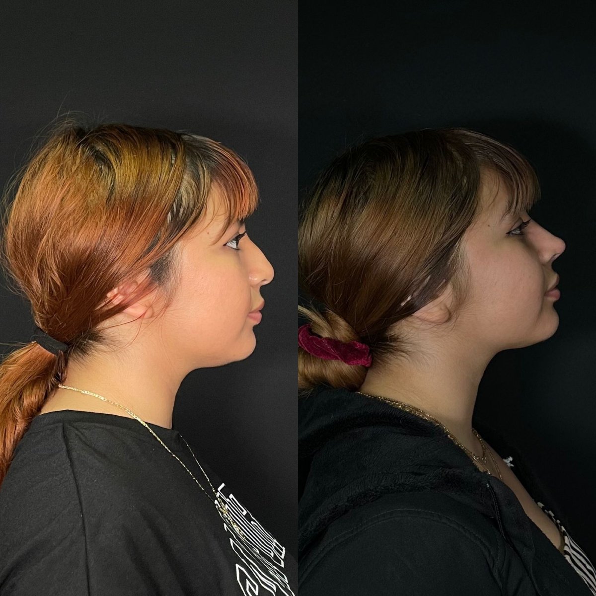 Resultados de rinoplastia antes y después en Zafir Medical Center, mejora de la nariz