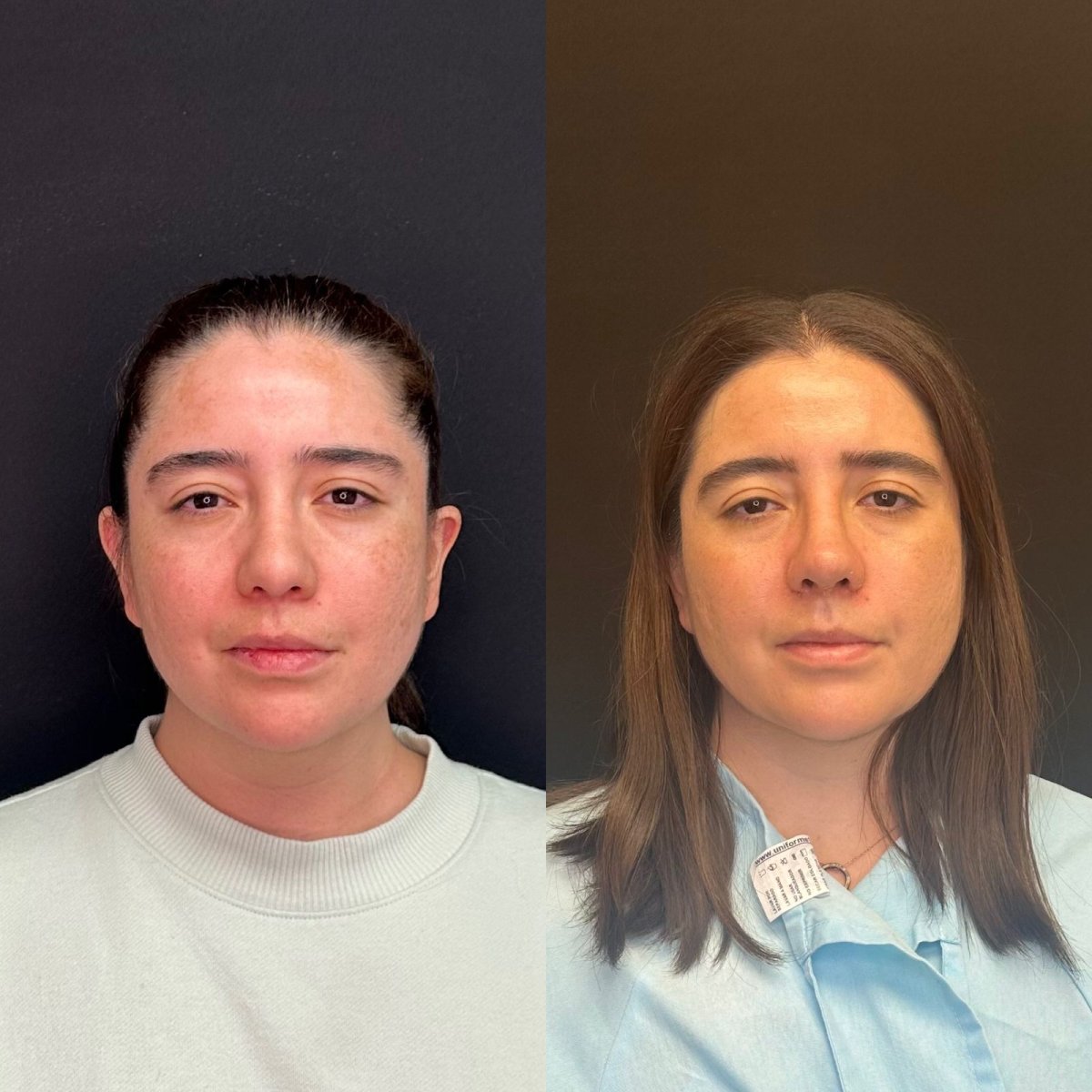 Resultados de rinoplastia antes y después en Zafir Medical Center, nariz con aspecto natural