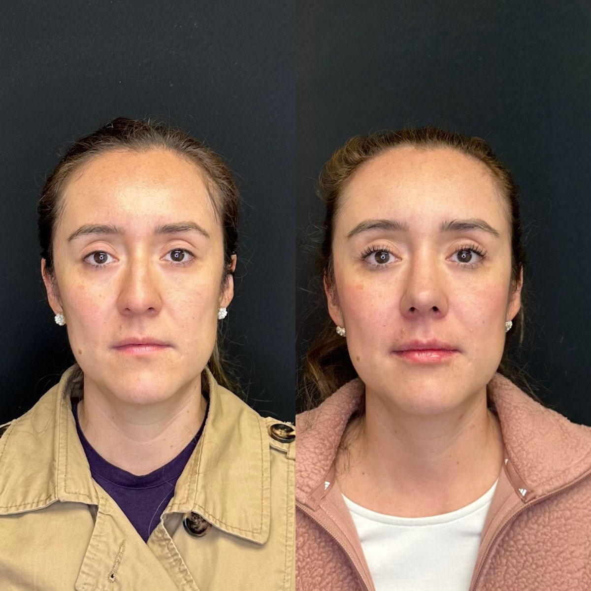 Resultados de rinoplastia antes y después en Zafir Medical Center, nariz de aspecto natural