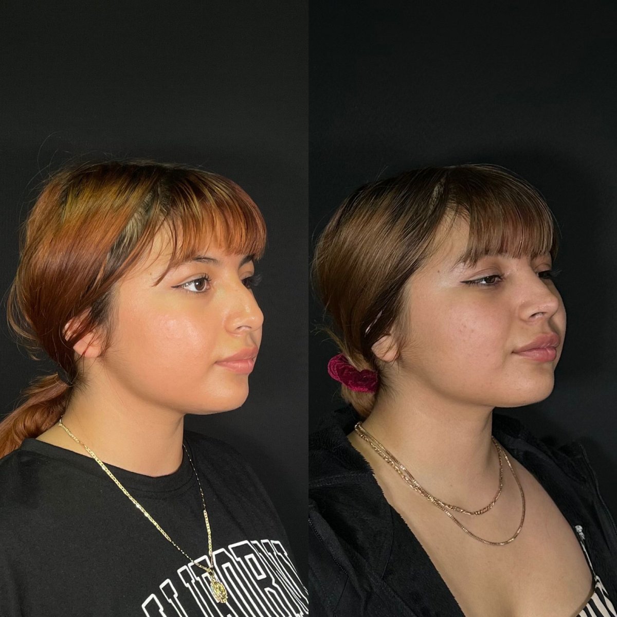 Resultados de rinoplastia antes y después en Zafir Medical Center, perfil nasal mejorado visible