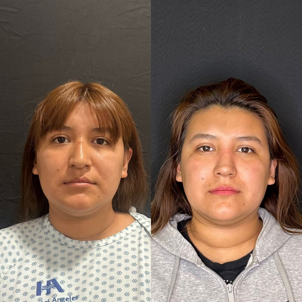 Resultados de rinoplastia antes y después en Zafir Medical Center, mejor forma y simetría nasal