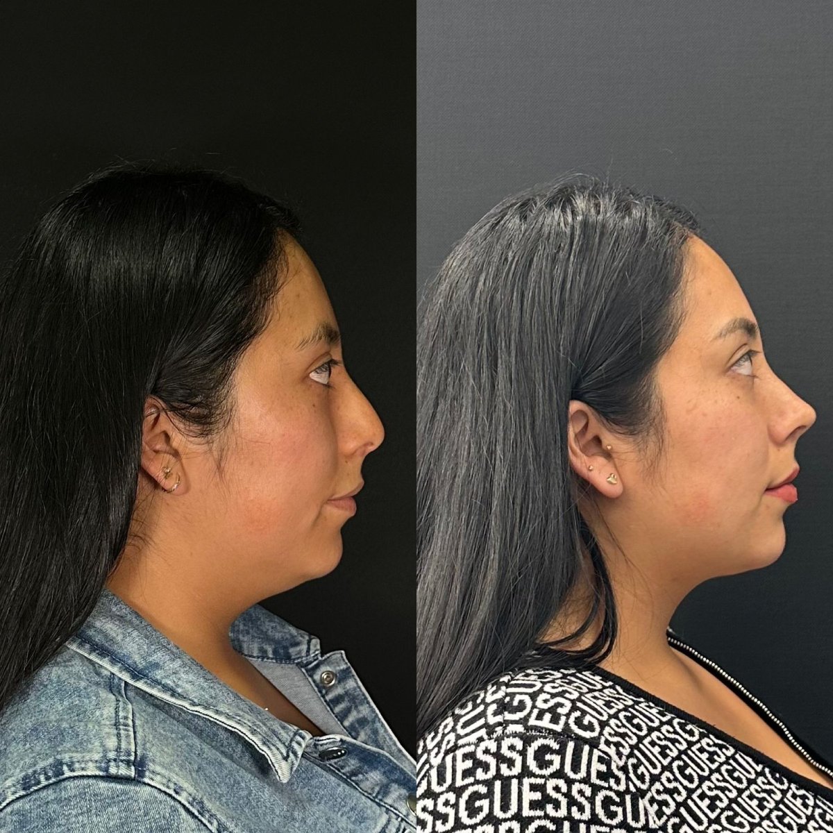 Before and after rhinoplasty results at Zafir Medical Center, improved nose profile