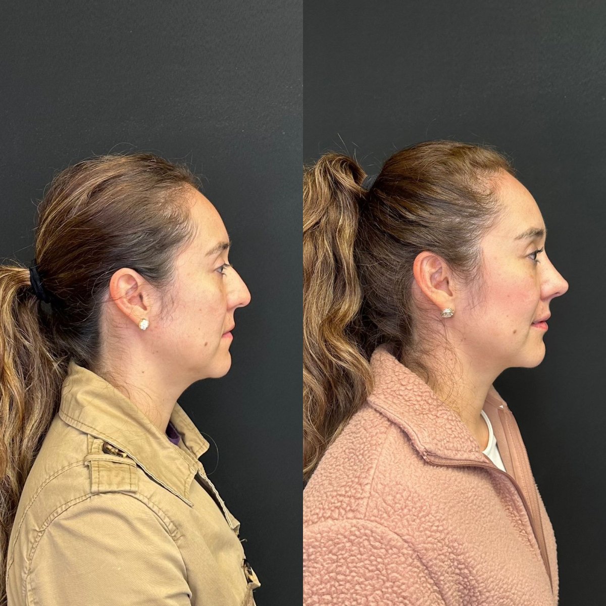 Before and after rhinoplasty at Zafir Medical Center, nose reshaping with natural result