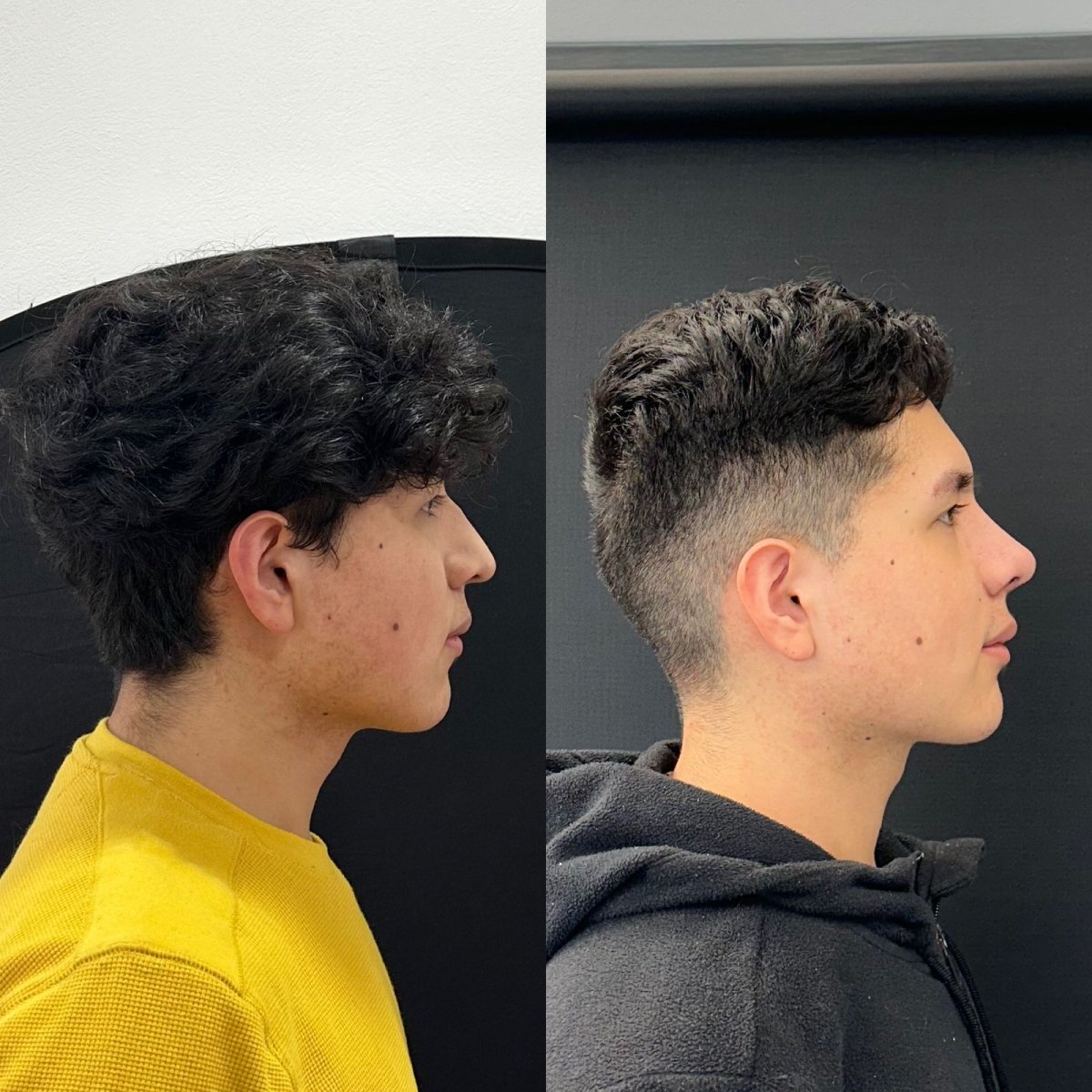 Before and after rhinoplasty results at Zafir Medical Center, improved nose profile