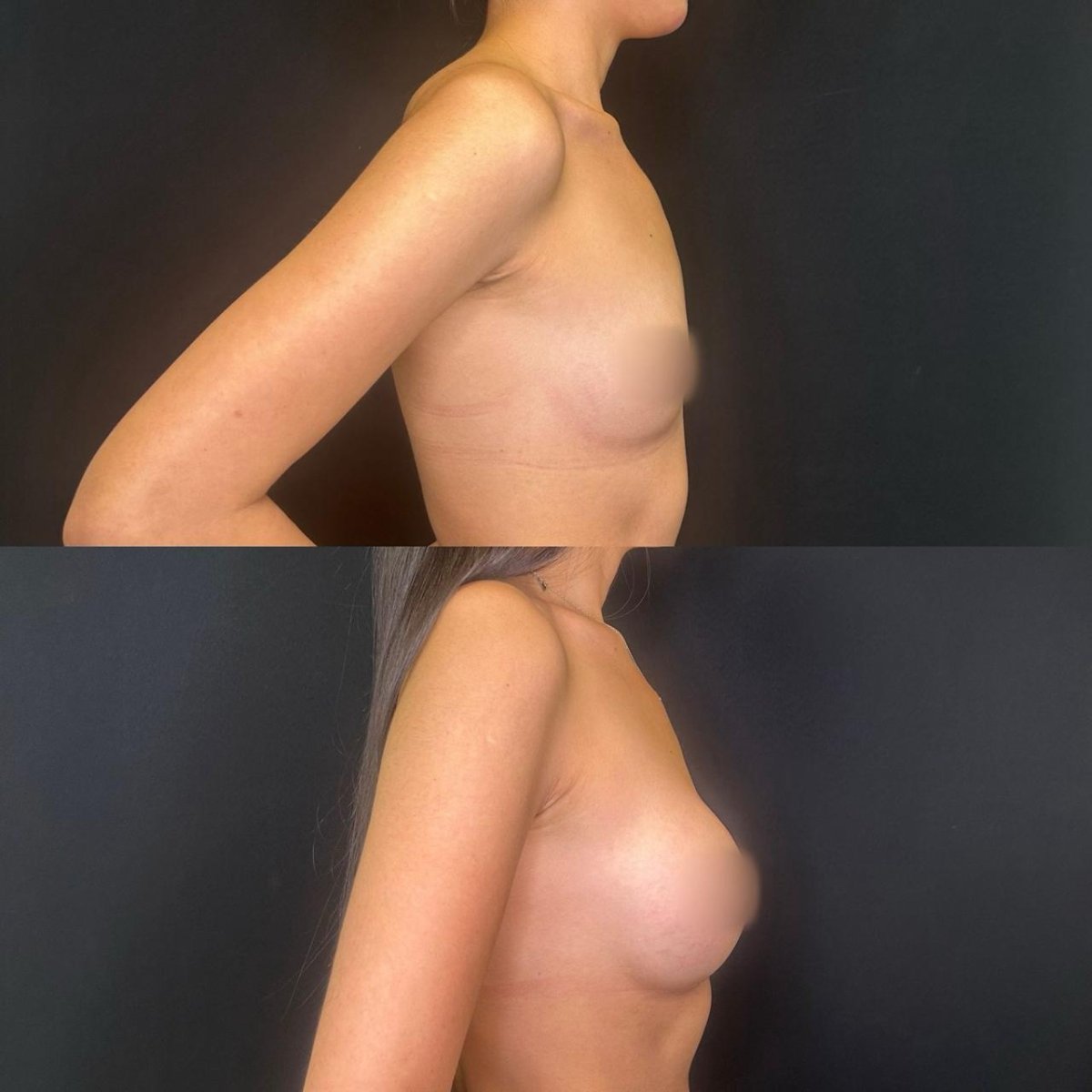 Before and after breast augmentation results at Zafir Medical Center, enhanced breast volume