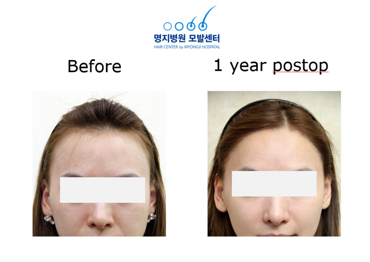 Before and after hair transplant result at Myongji Hospital – fuller hairline after 1 year