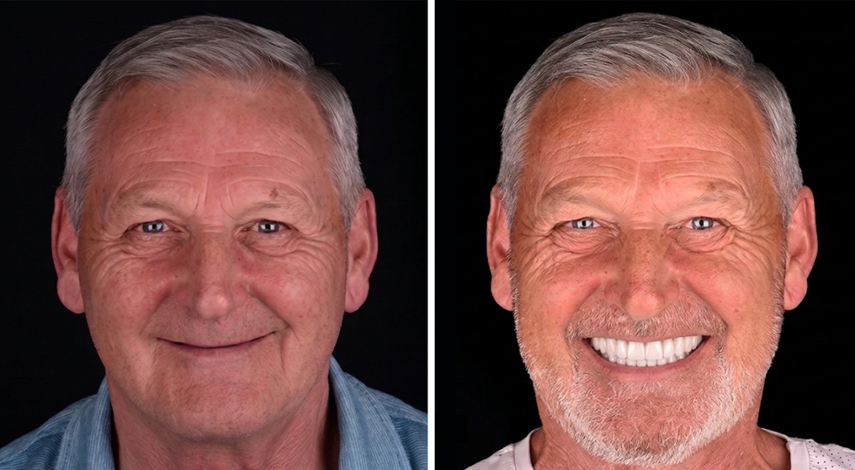 Vorher-nachher-Ergebnis All-on-4-Implantate bei VBright Dental – vollständige Zahnsanierung