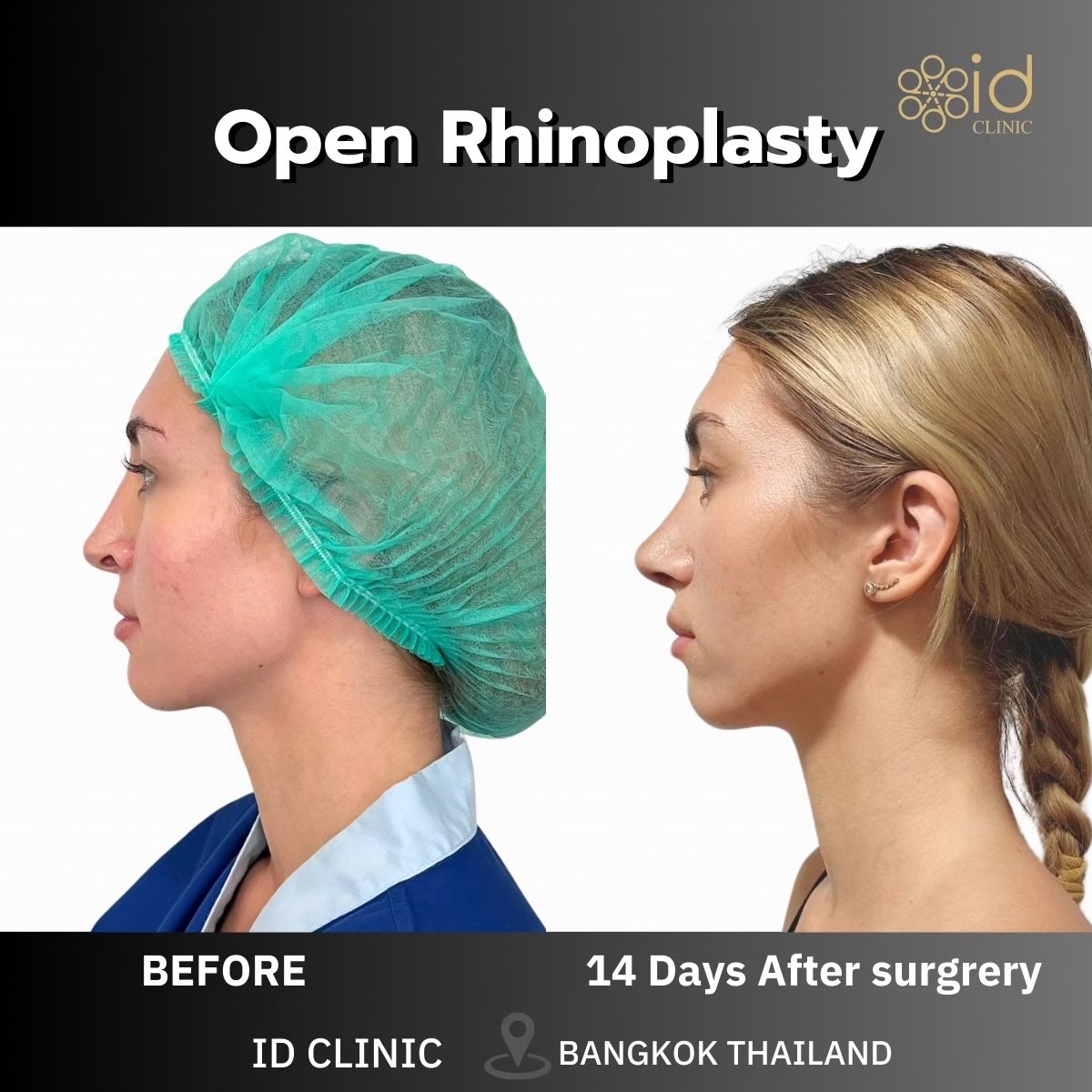 Результати до і після відкритої ринопластики в ID Clinic Bangkok, 14 днів після операції