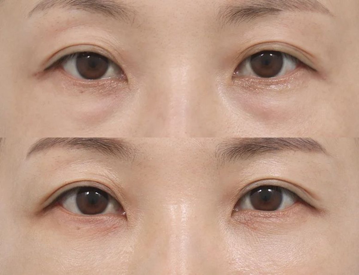 قبل وبعد نقل دهون الوجه في AB Plastic Surgery، تقليل الهالات تحت العين
