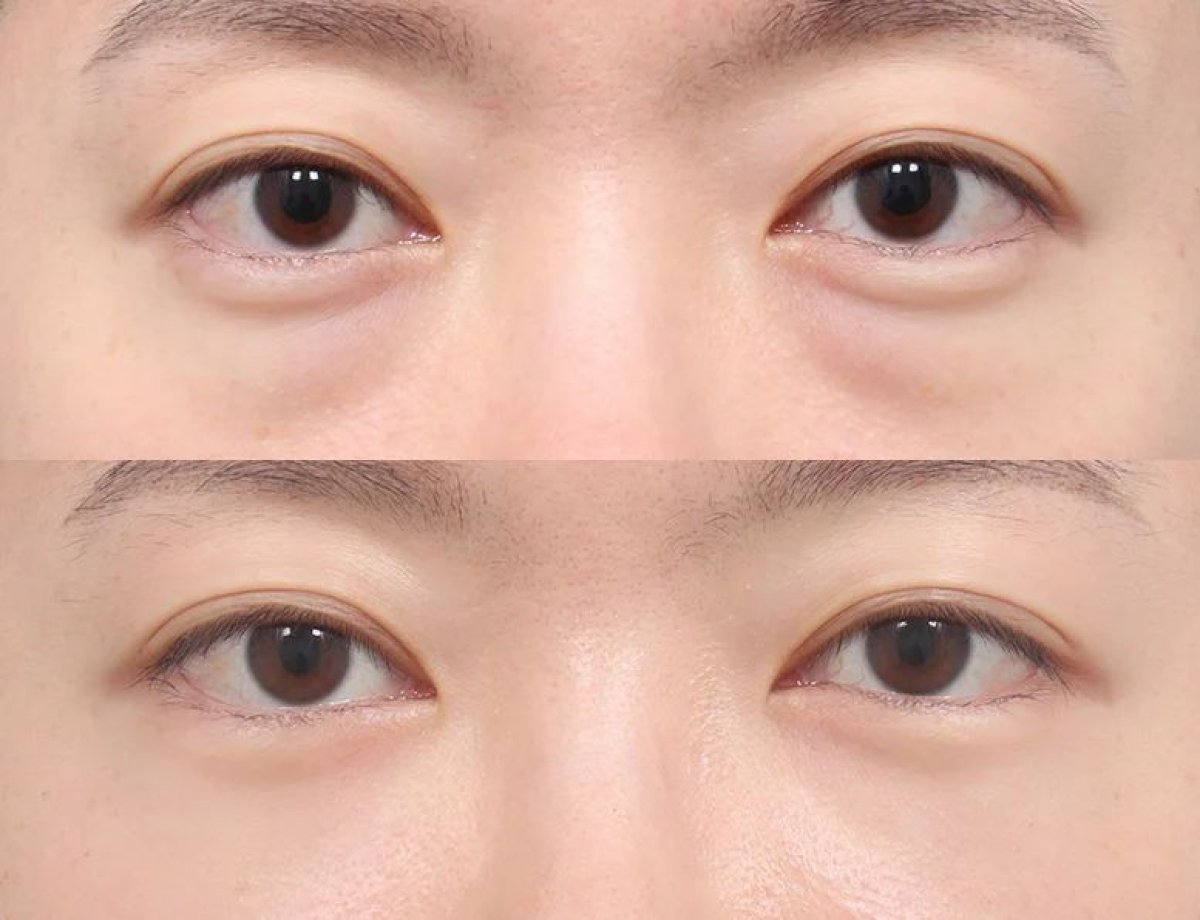 Before and after facial fat transfer at AB Plastic Surgery, under-eye volume restoration result