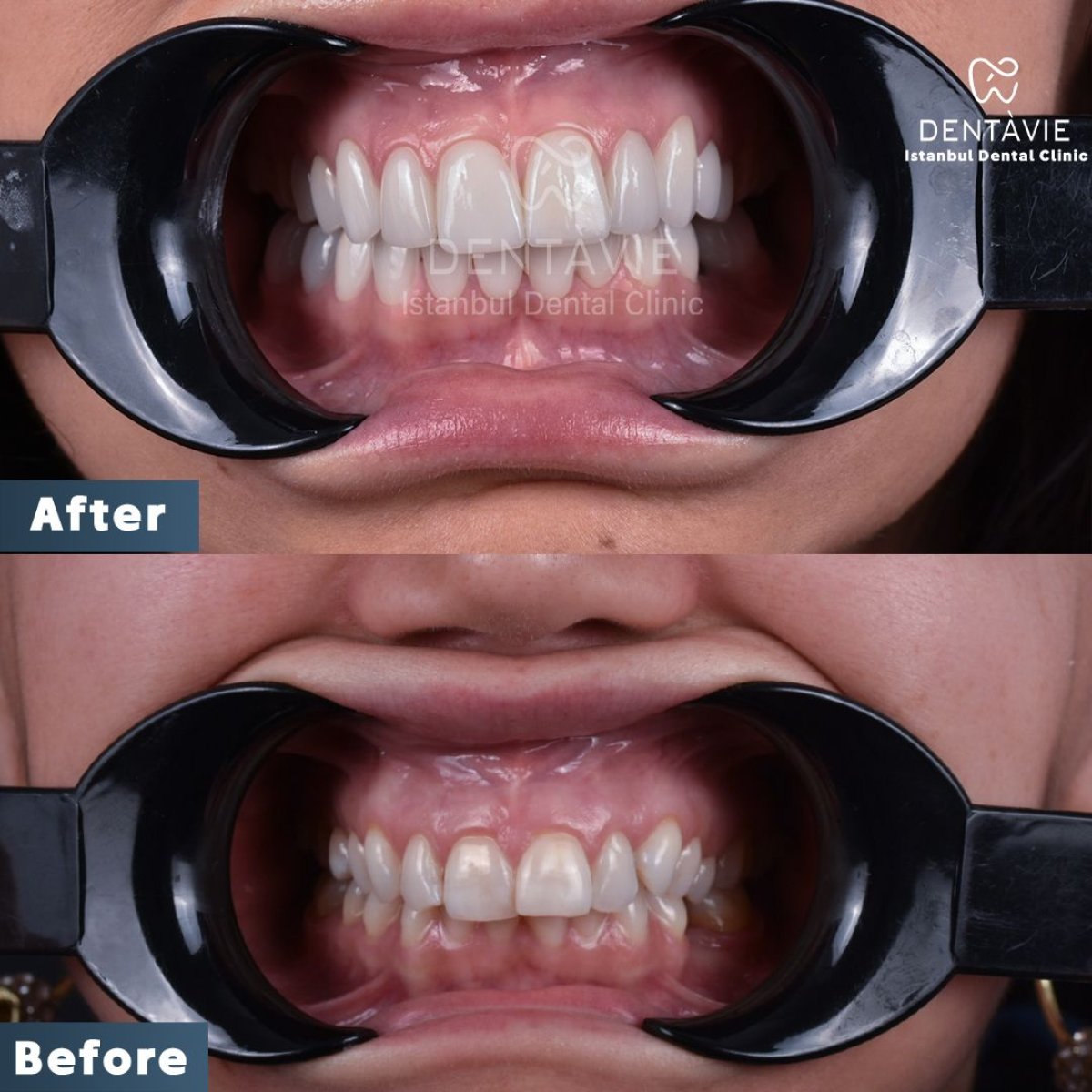 نتائج قبل وبعد ابتسامة هوليود في Dentavie Istanbul Dental Clinic، تحول الابتسامة