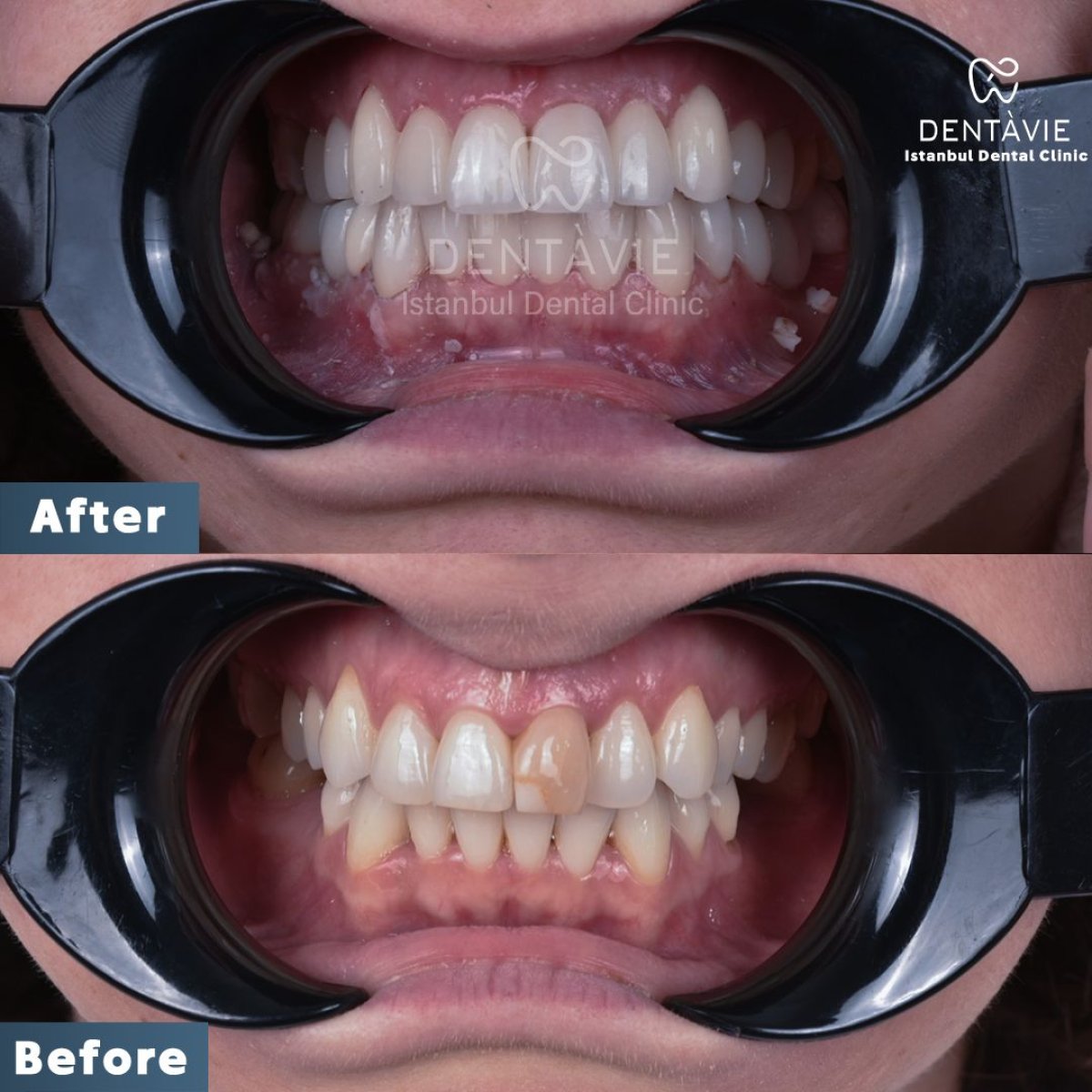 Resultados antes y después de Hollywood Smile en Dentavie Istanbul Dental Clinic, carillas dentales