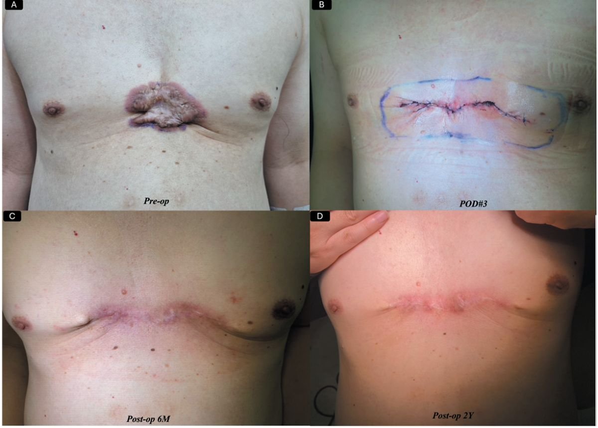 Resultados de injerto de piel por quemaduras antes y después en Xiamen Humanity Hospital, mejora de cicatriz