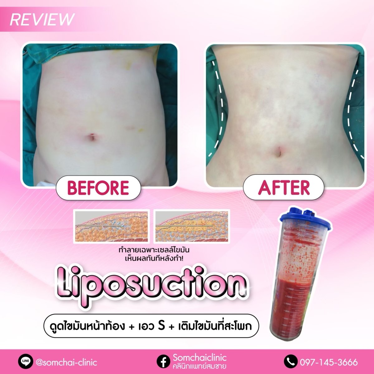 Resultados de liposucción antes y después en Somchai Clinic, reducción visible de grasa abdominal