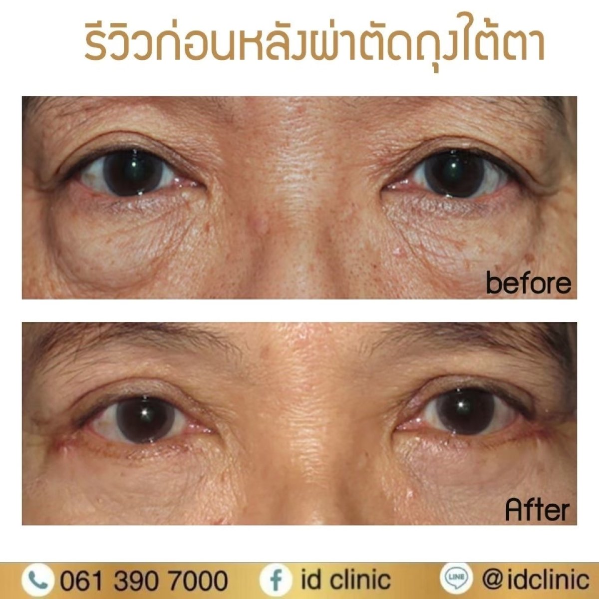 Результаты блефаропластики нижних век до и после в ID Clinic Bangkok, уменьшение мешков
