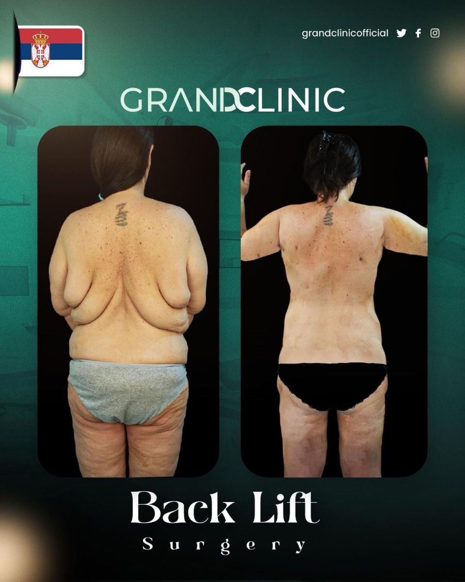 Vorher-nachher-Ergebnis Backlift-OP bei Grand Clinic – sichtbar verbesserte Rückenform