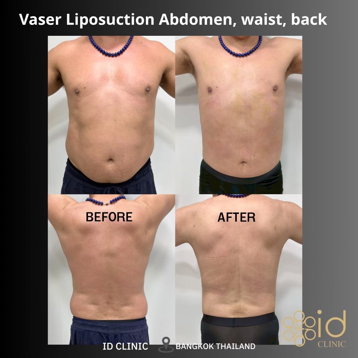 Résultats avant/après liposuccion 360 Vaser à ID Clinic Bangkok : abdomen, taille, dos