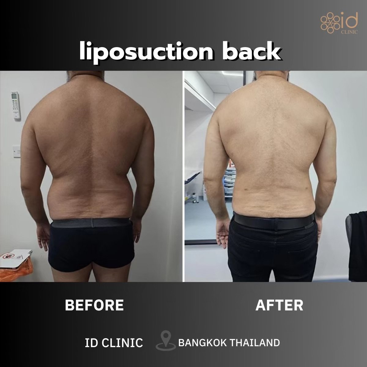 Resultados antes y después de liposucción 360 de espalda en ID Clinic Bangkok, reducción visible