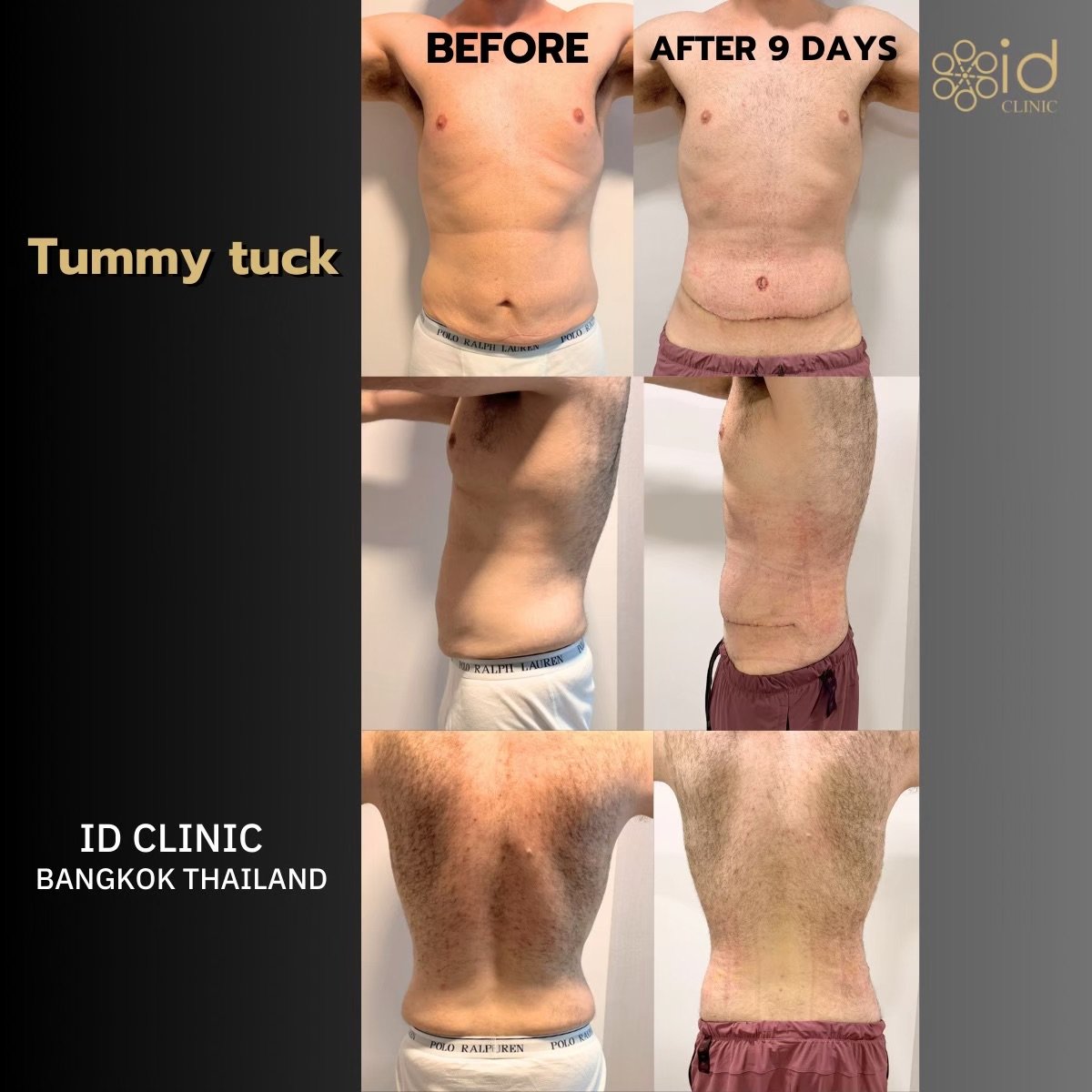Vorher-nachher-Ergebnis Bauchdeckenstraffung bei ID Clinic Bangkok, sichtbare Konturverbesserung